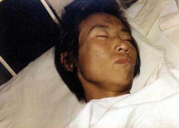 中医望皮肤之面黄如烟熏，阴黄