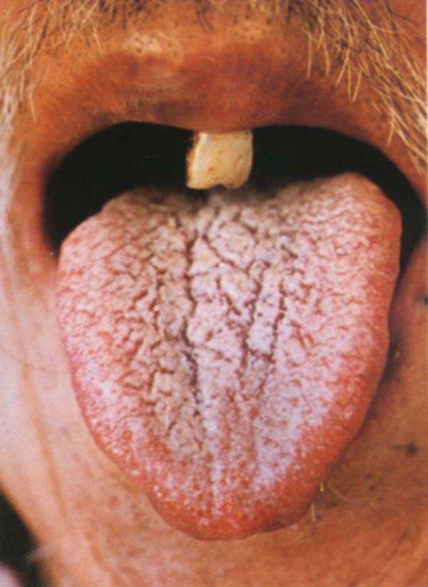 红舌白腐苔