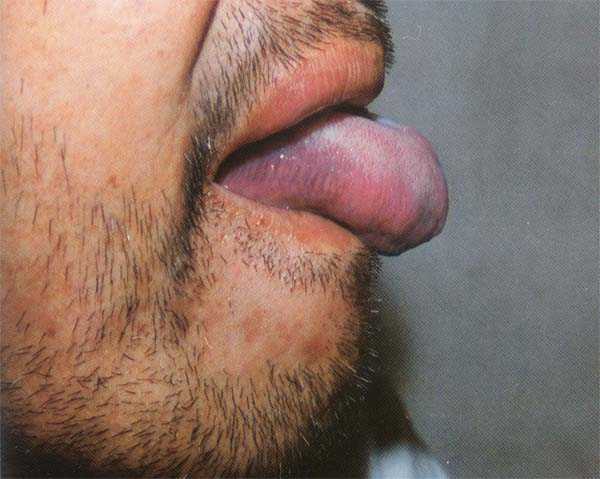 淡红紫斑舌薄白润苔