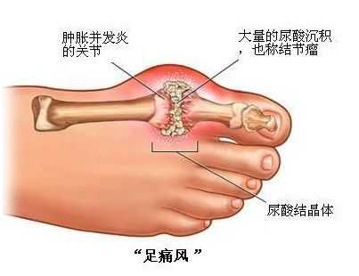 痛风偏爱男性的原因是什么