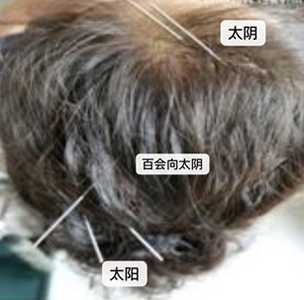 传承三阴三阳开阖枢理论创新针法