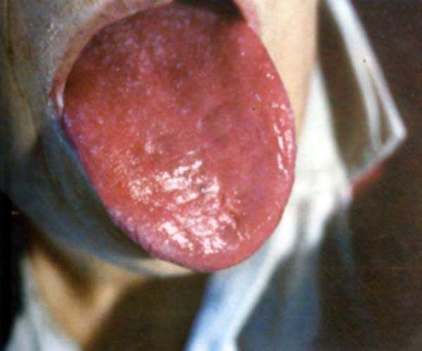 绛薄舌透明苔