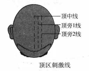飞针技术顶区刺激线