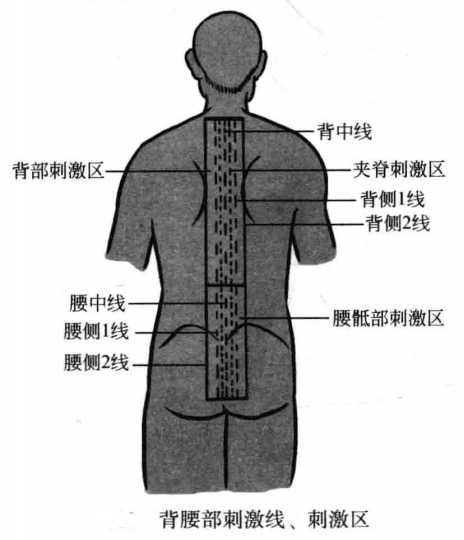 飞针技术脊缘部刺激线